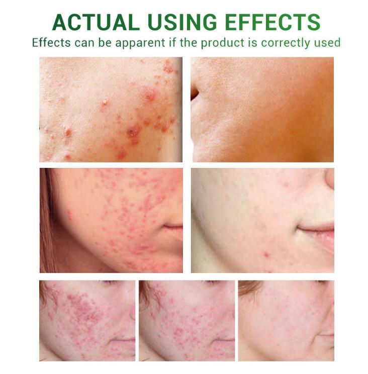 Acne Treatment Serum Facial Repair Oil Acne Treatment Serum Facial Repair Oil